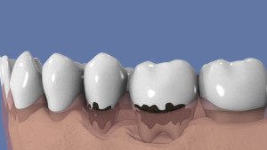 Le traitement non chirurgical de la parodontite